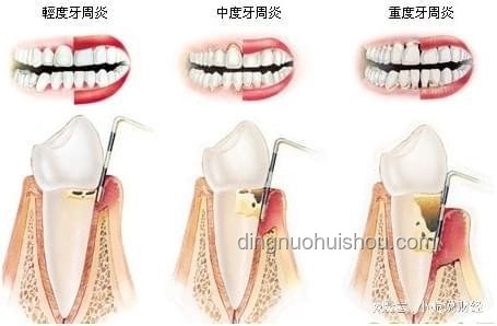 韦神牙周炎治疗全攻略，轻松守护口腔健康